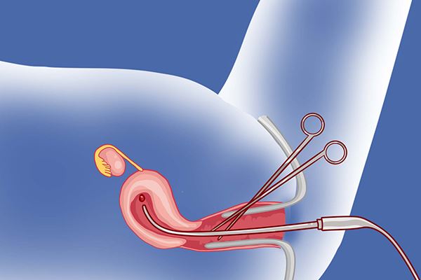 卵巢囊肿手术后一直流脏东西怎么回事，怎么办